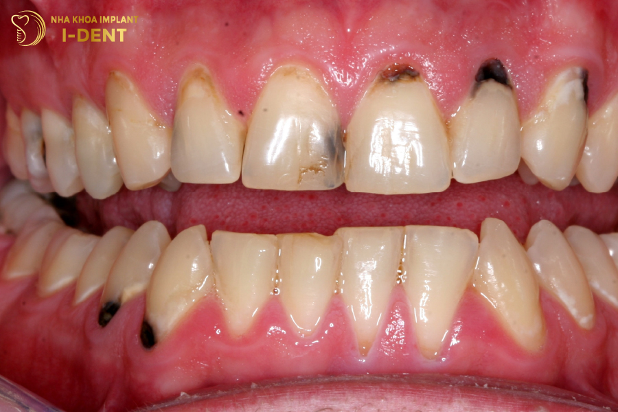 Sau khi tháo răng sứ cũ, nếu phát sinh bệnh lý răng miệng thì bác sĩ phải tiến hành điều trị