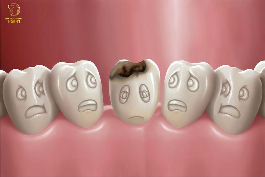 Sâu răng cần phải trám ngay để tránh nặng thêm và gây hại cho những răng khác