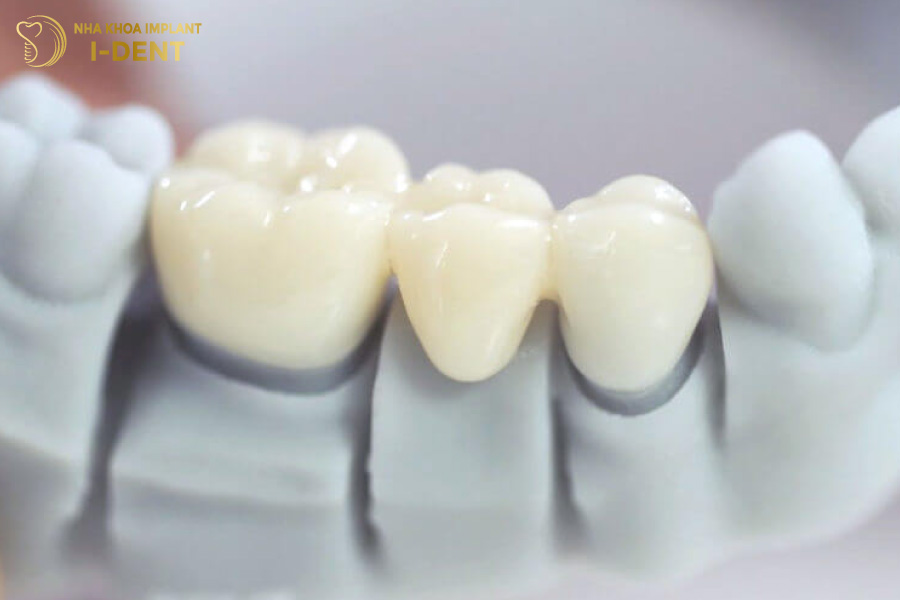 Màu sắc răng không bằng các loại răng toàn sứ cao cấp khác