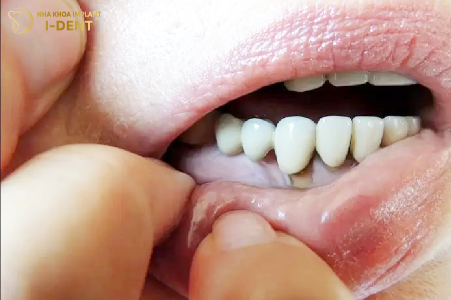 Tháo răng sứ làm lại trong những trường hợp nào?