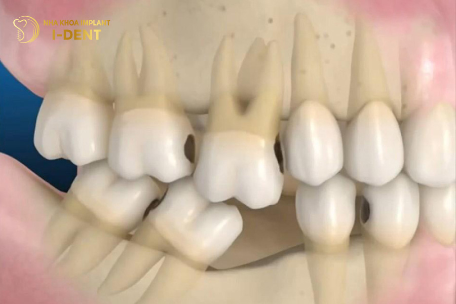 Mất chân răng gây ra hậu quả răng kế cận bị nghiêng ngả xô lệch