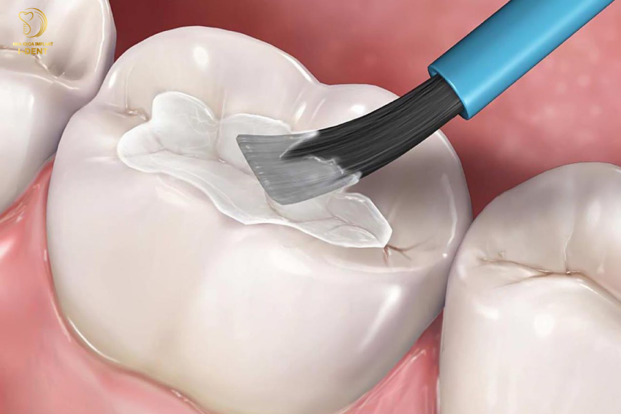 Răng sâu có nên nhổ - Trám răng cho những răng sâu nhẹ để khôi phục và bảo vệ răng