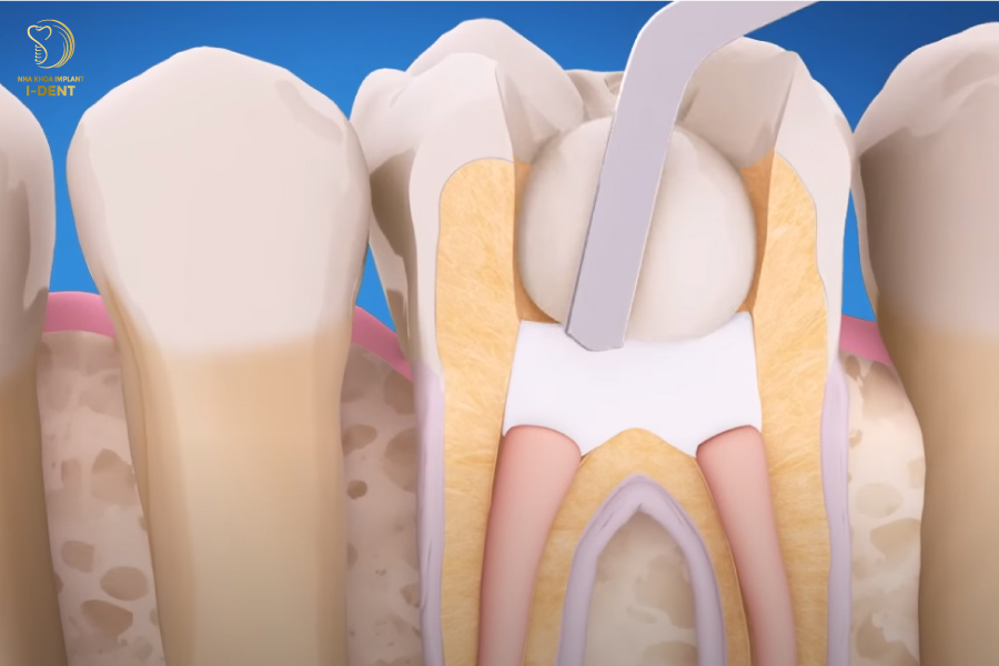Trám răng là phương pháp chữa trị răng sâu phổ biến