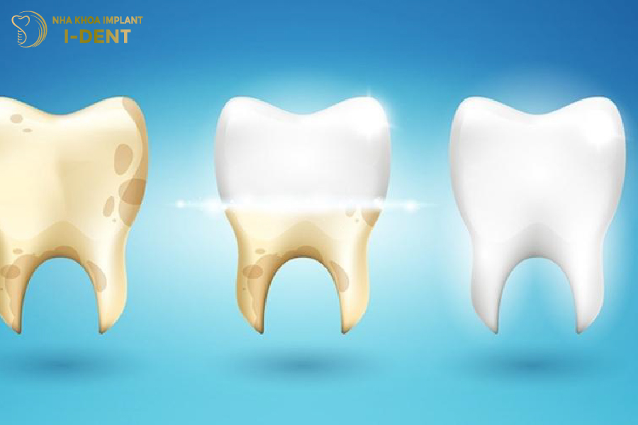 Tráng men răng giúp bảo vệ răng khỏi sâu và cải thiện màu sắc răng