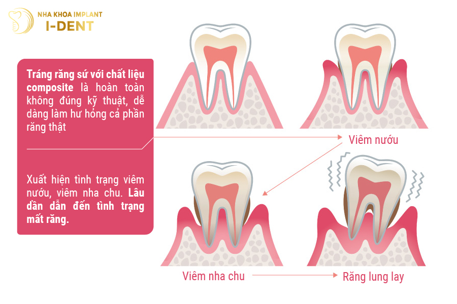 Tráng răng sứ ở cơ sở không uy tín có thể gây mất răng