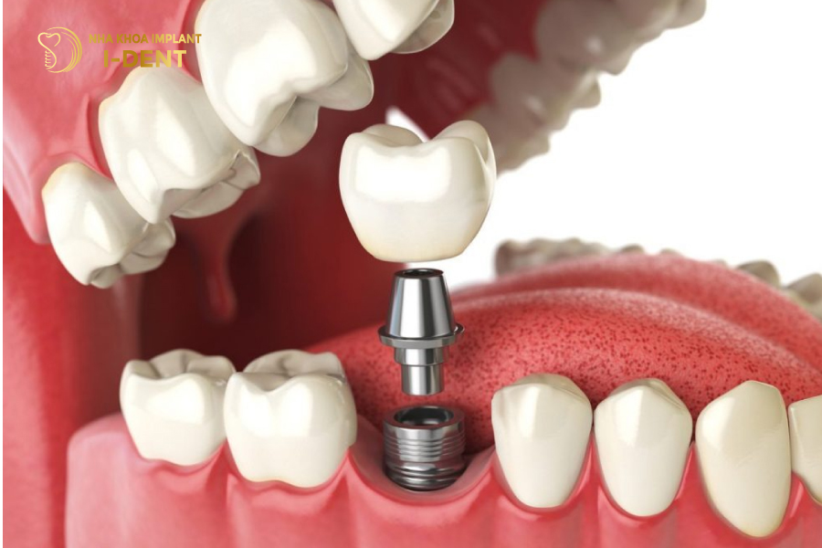 Tránh những tác động mạnh lên răng Implant