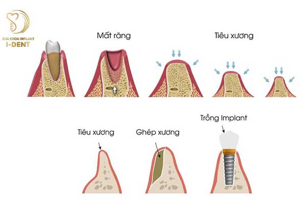 Làm răng giả tránh tình trạng tiêu xương