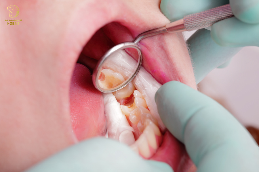 Trẻ em nên lấy tủy răng khi có dấu hiệu viêm nhiễm tủy nặng