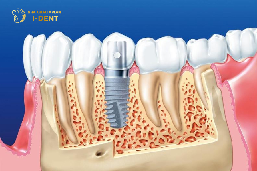 Trồng Implant có thể ngăn chặn được tình trạng tiêu xương hàm