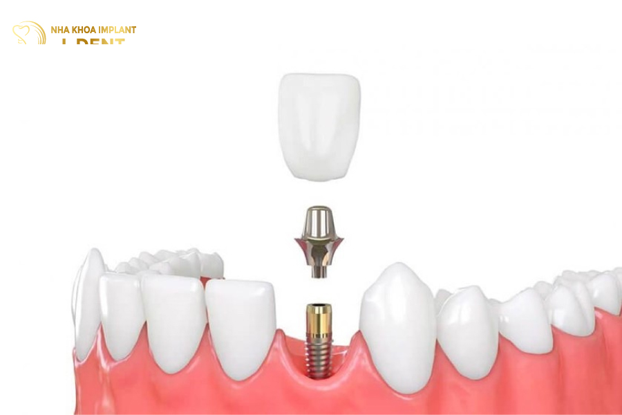 Phương pháp trồng răng implant