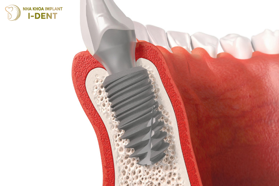 Trồng răng implant khác phục được tình trạng tiêu xương hàm