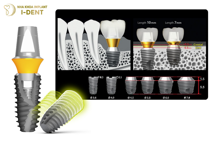 Trụ Implant Mỹ có công nghệ xử lý vùng cổ Implant khác nhau