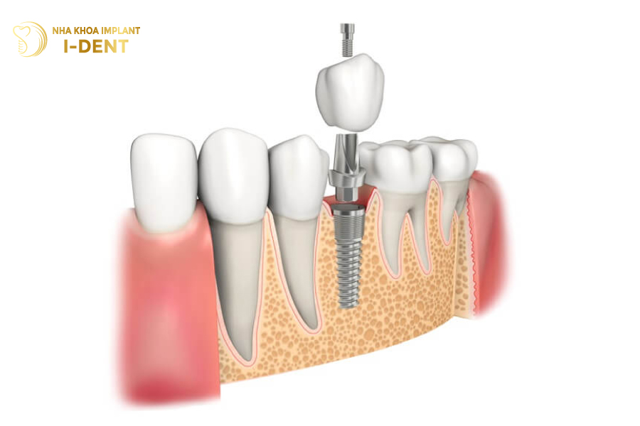 tuổi thọ răng implant