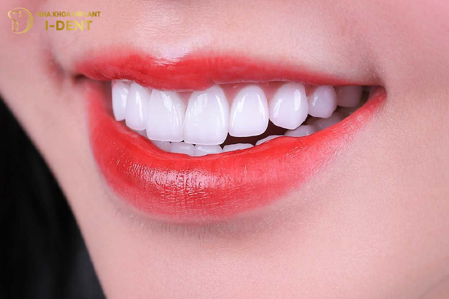 Tuổi thọ trung bình của răng sứ HT Smile là 15 năm 