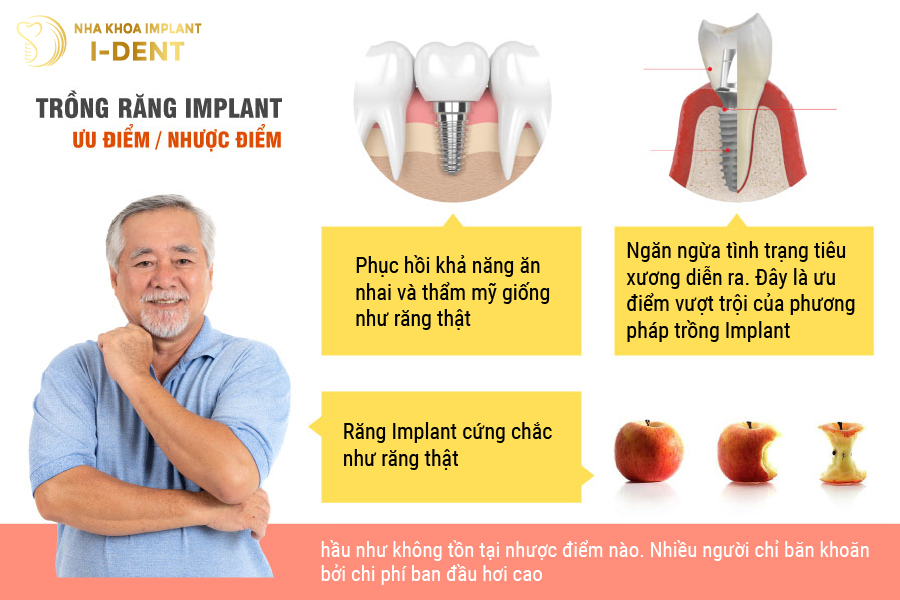 Ưu nhược điểm trồng răng Implant