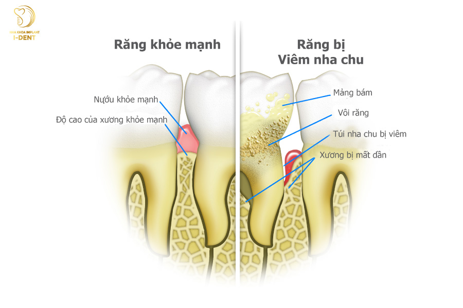 Vì sao răng khểnh lại dễ gây các bệnh lý răng miệng như viêm nha chu?