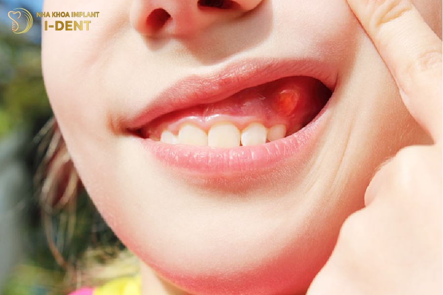 Vùng lợi giữa răng sứ và nướu sưng đỏ do nhiễm trùng