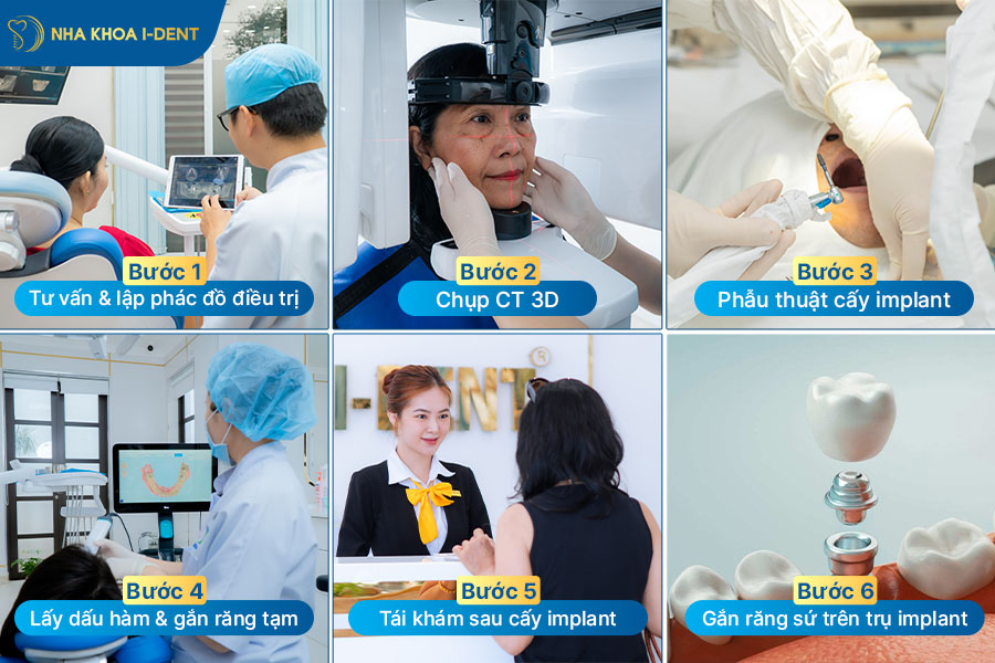 cấy implant all on 4