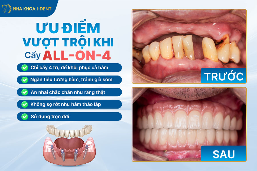 implant all on 4 là gì