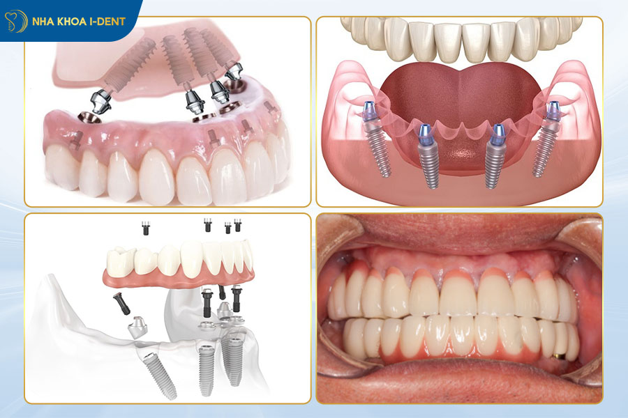 trồng răng implant all on 4