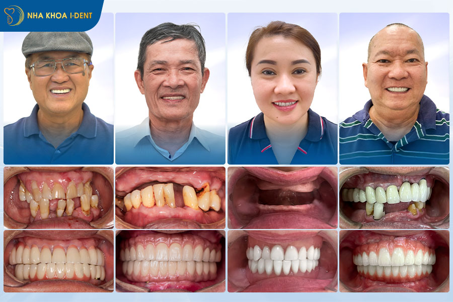 Trồng răng toàn hàm All on 4