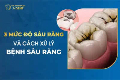 3 Mức Độ Sâu Răng Và Cách Xử Lý Bệnh Sâu Răng