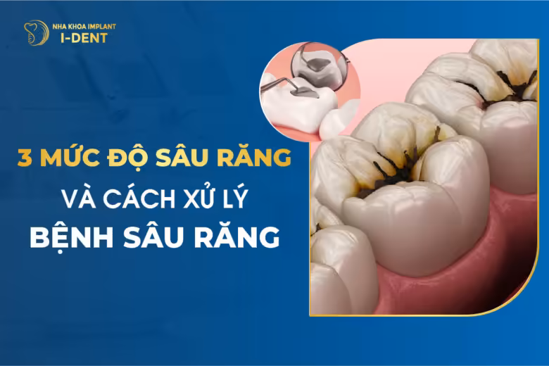 3 Mức Độ Sâu Răng Và Cách Xử Lý Bệnh Sâu Răng