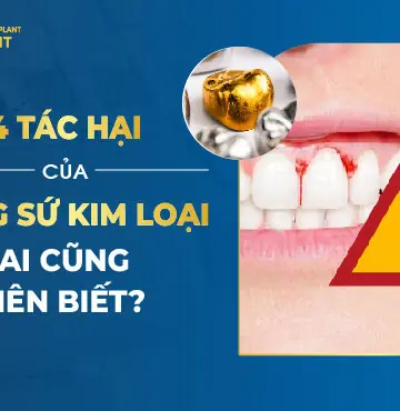 Các Tác Hại Răng Sứ Kim Loại Cần Lưu Ý