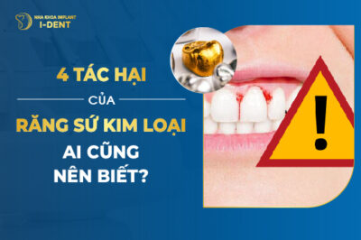 Các Tác Hại Răng Sứ Kim Loại Cần Lưu Ý