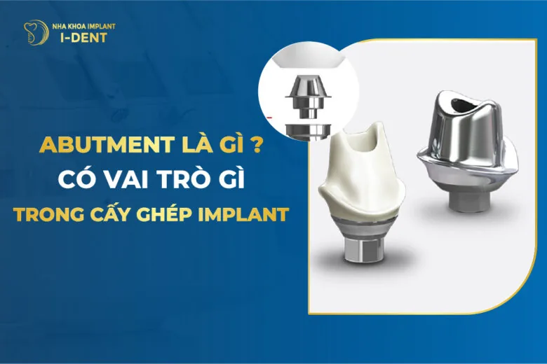 Abutment Implant Là Gì Có Vai Trò Gì Trong Cấy Ghép Implant