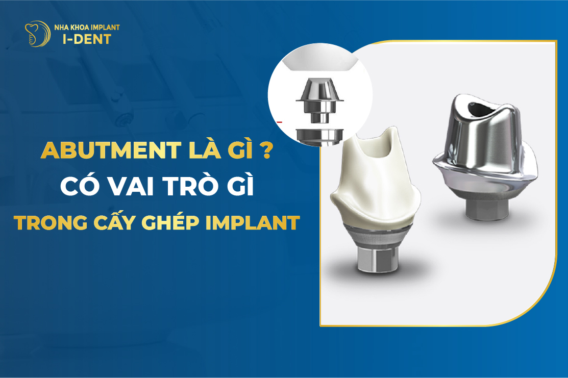 Abutment Implant Là Gì? Có Vai Trò Gì Trong Cấy Ghép Implant?