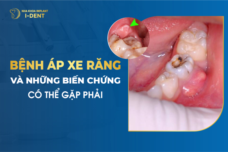 Bắt Buộc Nhổ Răng Nếu Gặp Phải Những Trường Hợp Này
