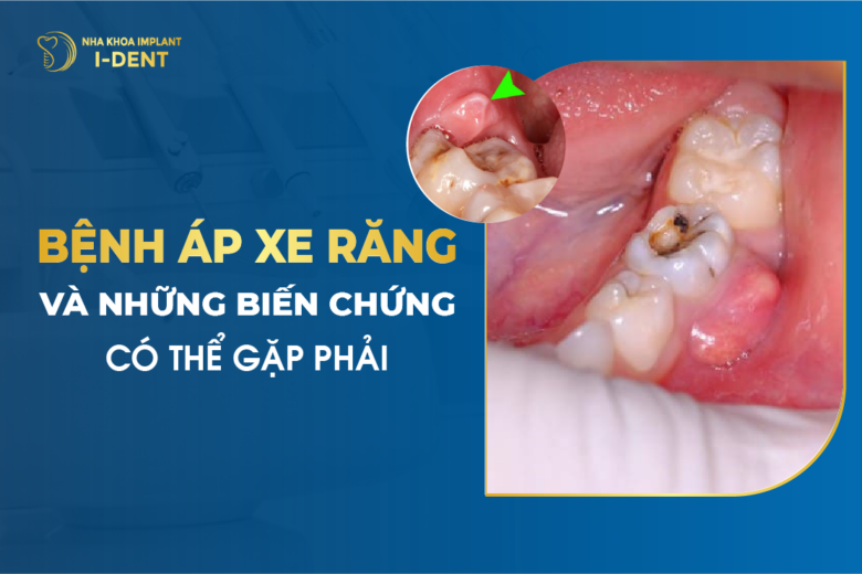 Bệnh Áp Xe Răng Và Những Biến Chứng