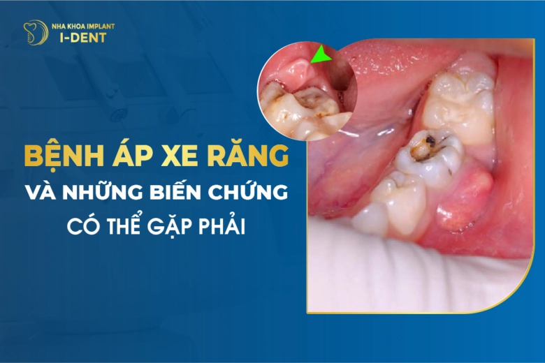 Bắt Buộc Nhổ Răng Nếu Gặp Phải Những Trường Hợp Này