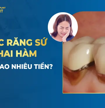 Bọc Răng Sứ Hai Hàm Giá Bao Nhiêu Tiền?
