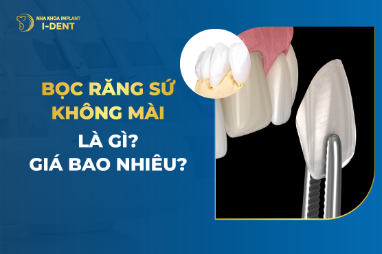 Bọc Răng Sứ Không Mài Là Gì? Giá Bao Nhiêu?