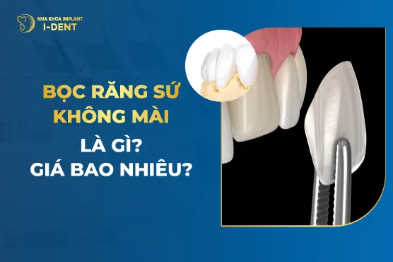 Giá Bọc Răng Sứ Không Mài Bao Nhiêu?