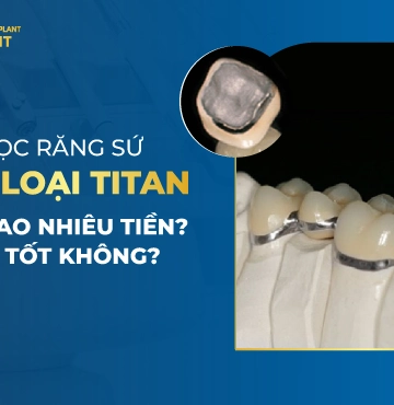 Bọc Răng Sứ Kim Loại Titan Giá Bao Nhiêu Tiền- Có Tốt Không-