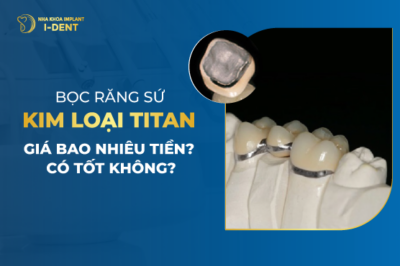 Bọc Răng Sứ Kim Loại Titan Giá Bao Nhiêu Tiền- Có Tốt Không-