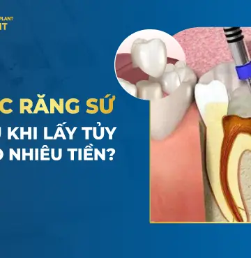 Lấy tủy bọc răng sứ giá bao nhiêu?