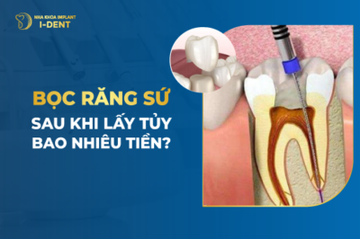 Lấy tủy bọc răng sứ giá bao nhiêu?