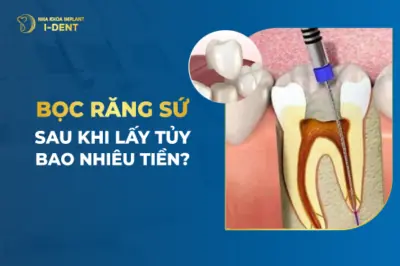 Lấy tủy bọc răng sứ giá bao nhiêu?