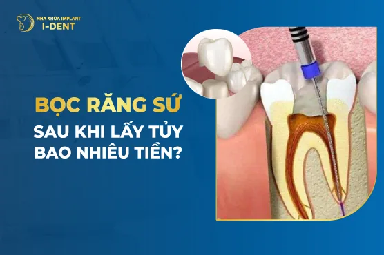 Lấy tủy bọc răng sứ giá bao nhiêu?