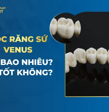 Bọc răng sứ Venus giá bao nhiêu- Có tốt không-