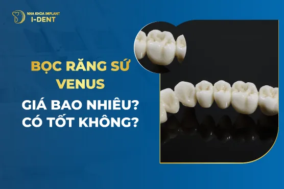 Bọc răng sứ Venus giá bao nhiêu- Có tốt không-