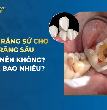 bọc răng sứ cho răng sâu bao nhiêu tiền