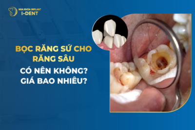 bọc răng sứ cho răng sâu bao nhiêu tiền