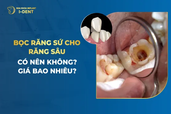 bọc răng sứ cho răng sâu bao nhiêu tiền