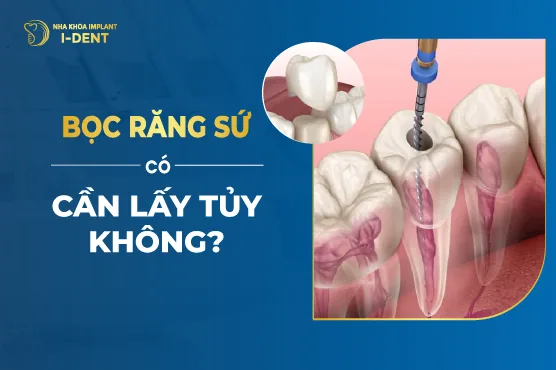 Răng Lấy Tủy Có Nên Bọc Lại Không?