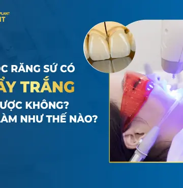 Bọc răng sứ có tẩy trắng được không- Cách làm như thế nào-
